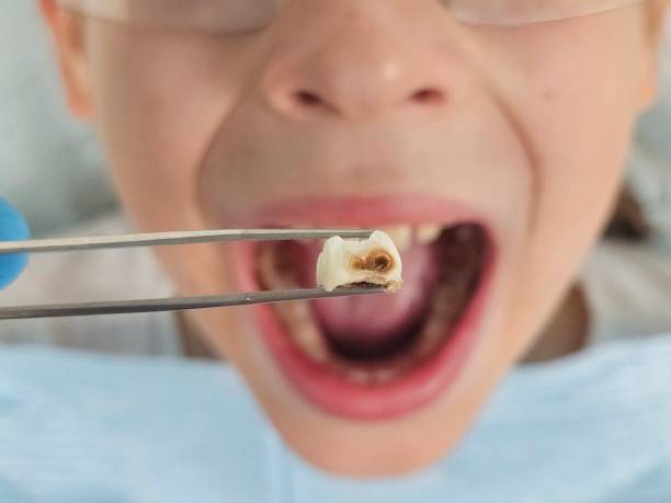Best Emergency Dentist for Lost Fillings or Crowns in Tamiami, FL